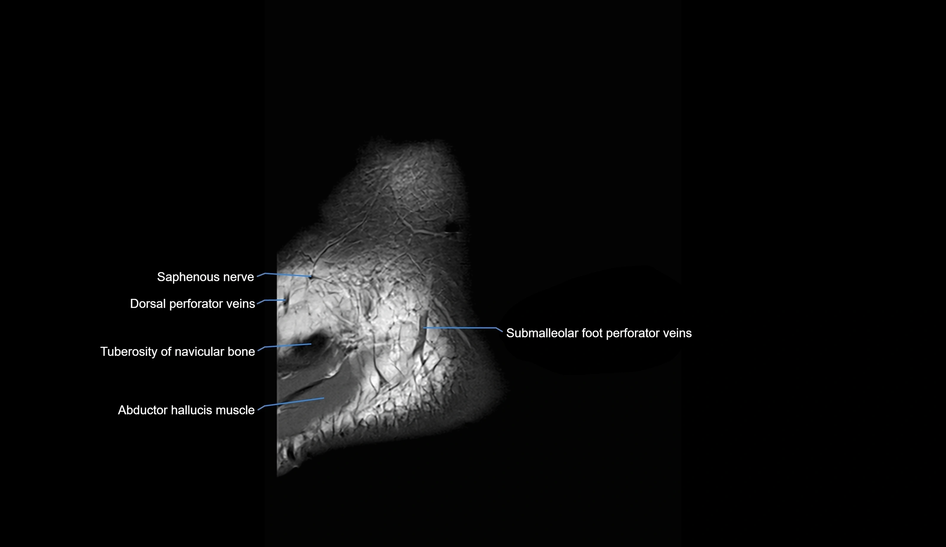 MRI Ankle sagittal cross sectional anatomy 3T  radiology  image-img-00001-00001.webp